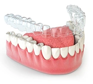 Clear aligner trays used to straighten teeth and improve smile alignment